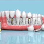 Exploring Advanced Oral Care Treatments: What’s New in Dentistry?